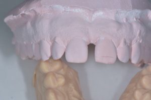 molde dental de paciente con hueco dentario antes de tratamiento