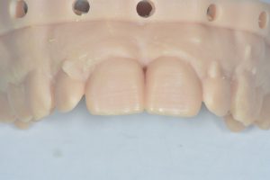 molde dental de paciente con hueco dentario después de tratamiento