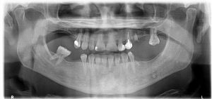 Radiografía Dental - Dr Calvo Guirado - Clínica dental Murcia